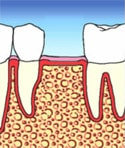 Zahnlcke mit geschlossener Knochensubstanz