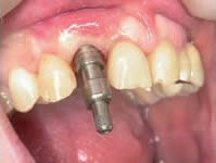 Abdruckpfosten auf Implantat verschraubt